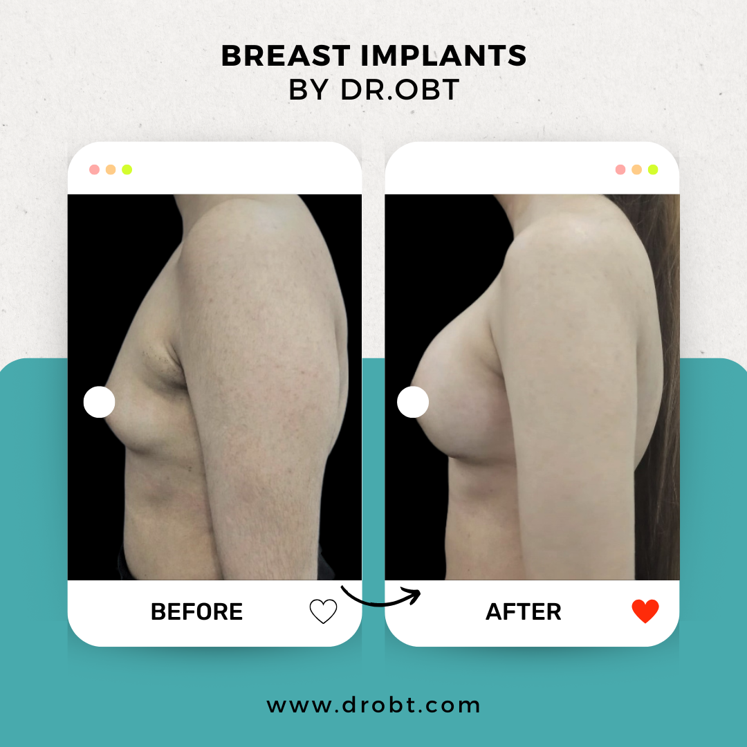 Breast Augmentation in Lahore