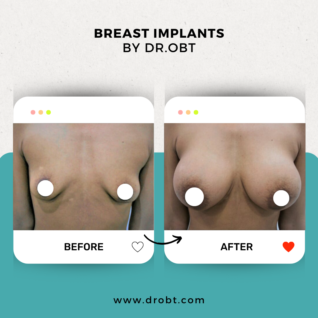 Breast Augmentation in Lahore