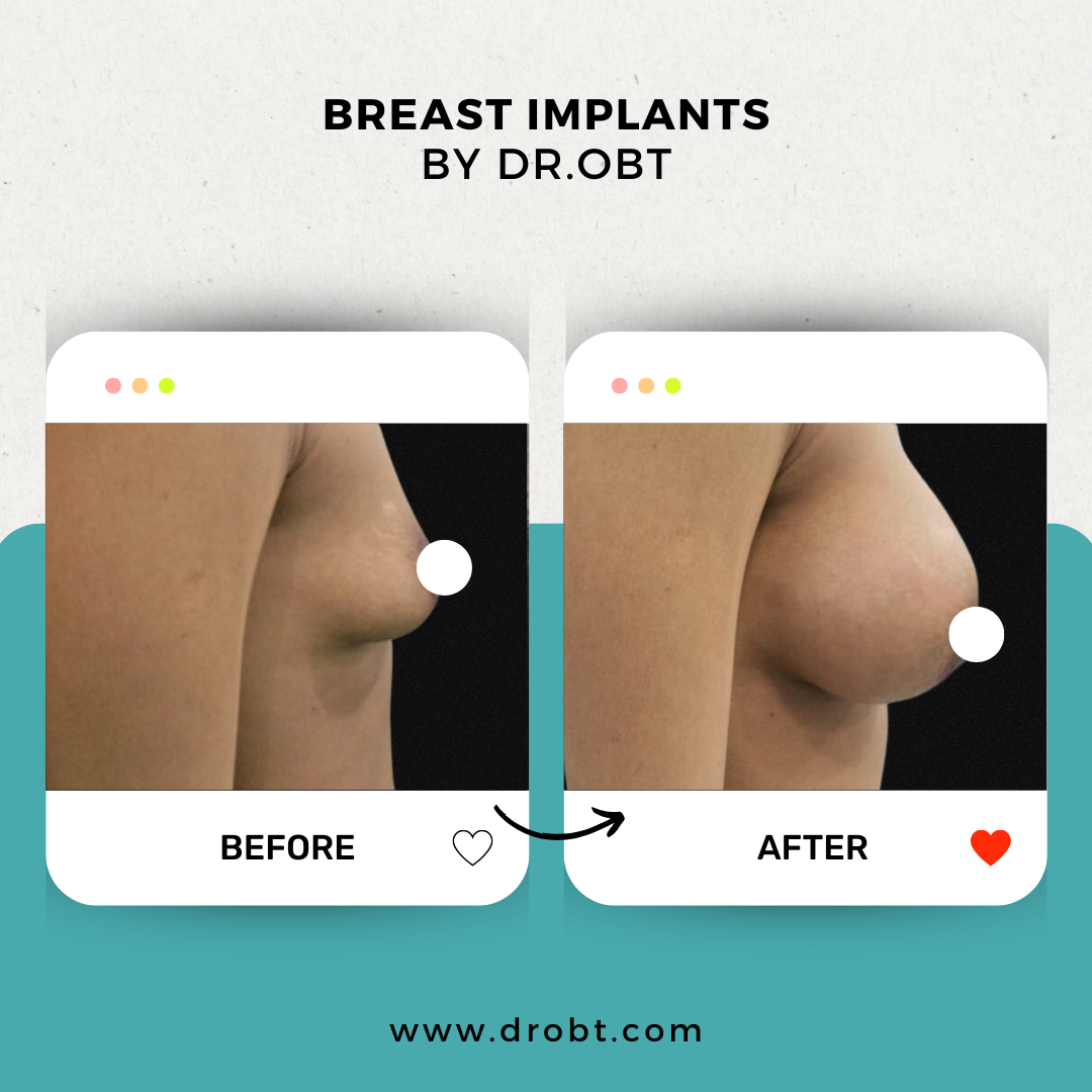 Breast-Implants-3